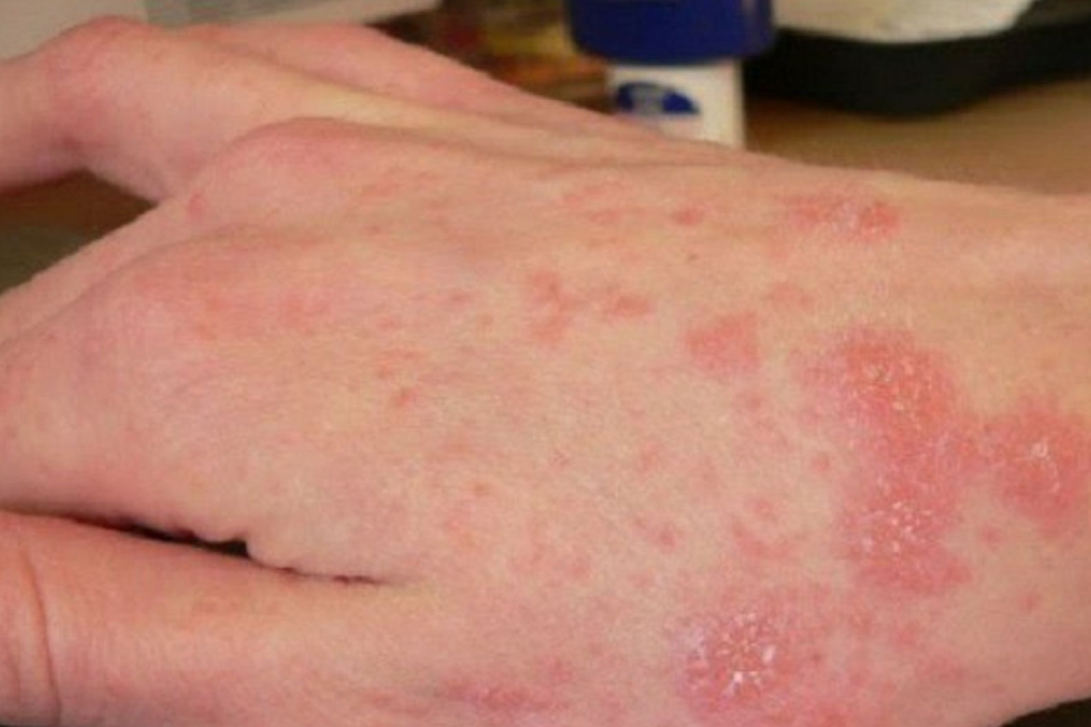 Viêm nang lông da đầu do nấm Malassezia