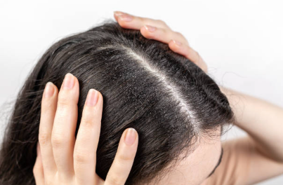 Tóc trở nên bết dính là do tuyến bã nhờn, kết hợp với bụi bẩn, mồ hôi.