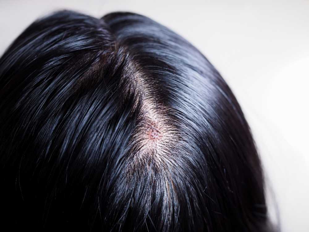 Da đầu đỏ, tóc bết nhẹ, thể hiện tình trạng viêm tiết bã nhờn.