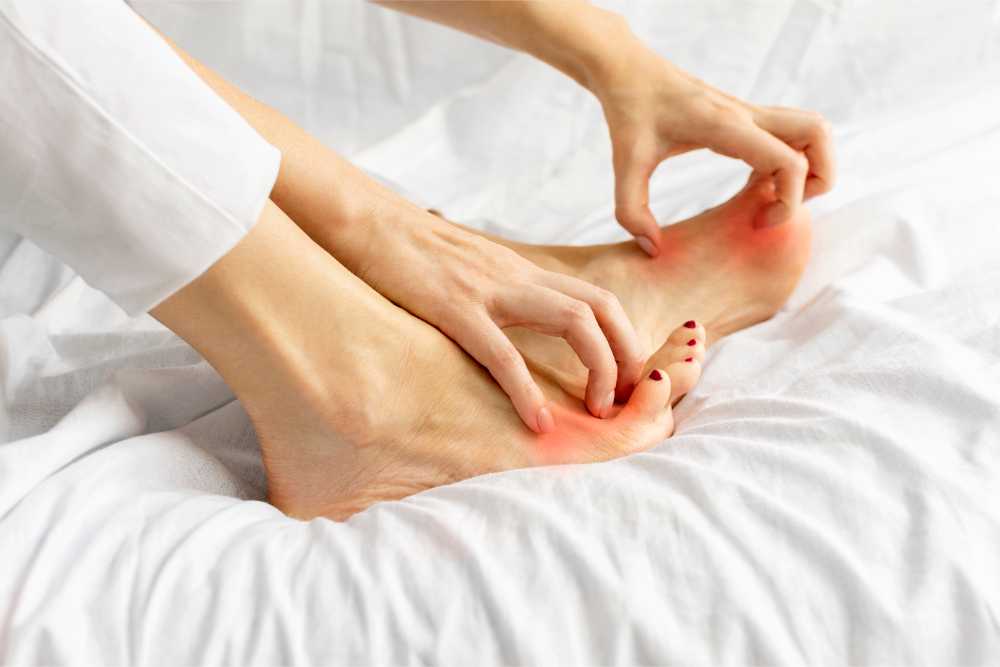 Làn da bị nấm kẽ chân bị ngứa rát